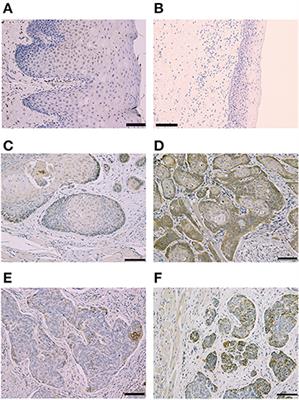 Combination of Clptm1L and TMEM207 Expression as a Robust Prognostic Marker in Oral Squamous Cell Carcinoma